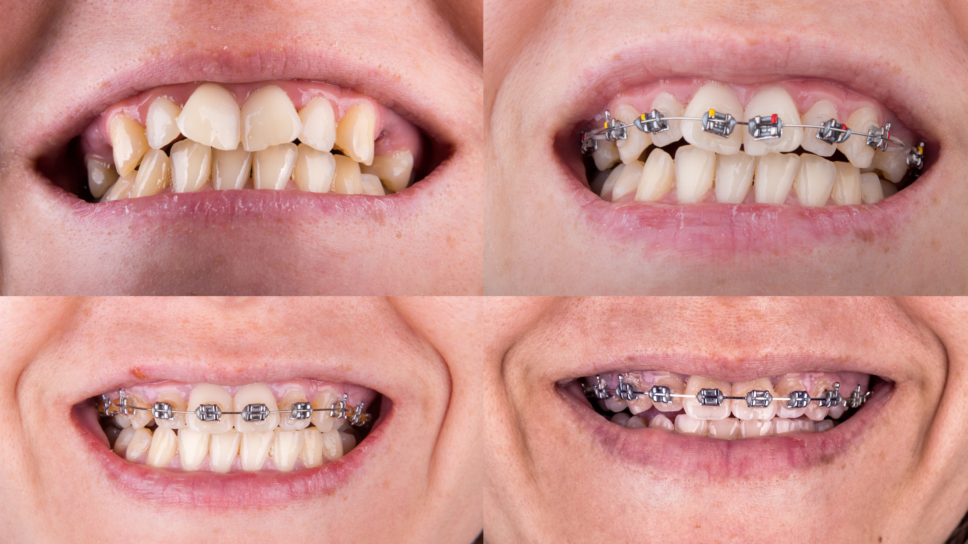 Invisalign-Profiles-1024x927